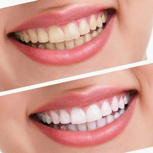BloomVenus DazzlingSmile™ Teeth Whitening Dental Kit
